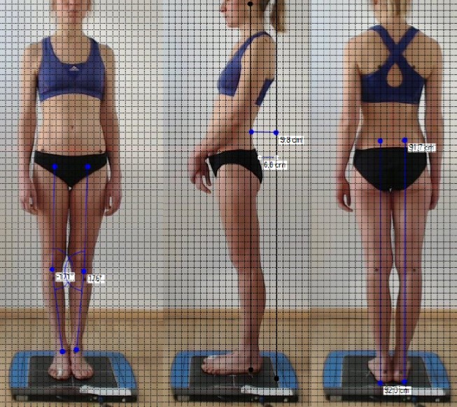 analyse posturale rachis montpellier kiné du sport rachis douleur lombalgie dorsalgie cervicalgie sciatique sciatalgie renforcement dos ergonomie